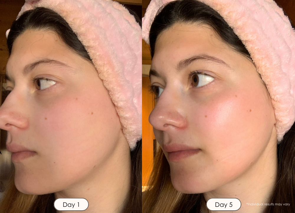 Ice Roller Cryotherapy Treatment before and after results showing reduced puffiness and brighter skin