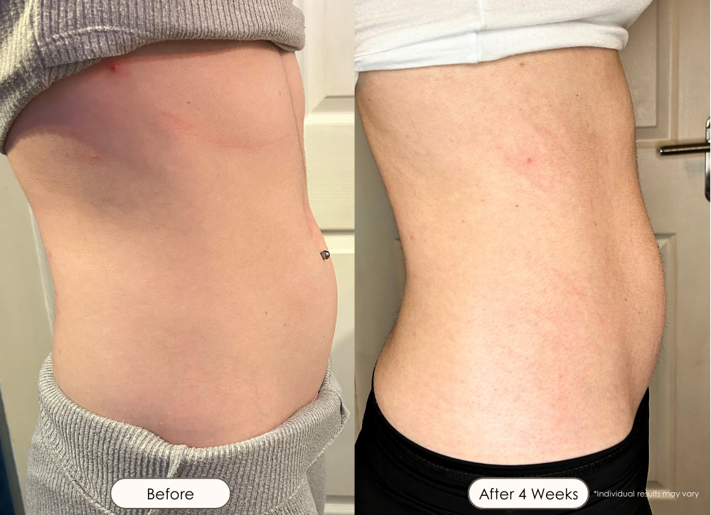 Sera vacuum body contour device before and after where there is a visible reduction of fat around the abdomen after 4 weeks