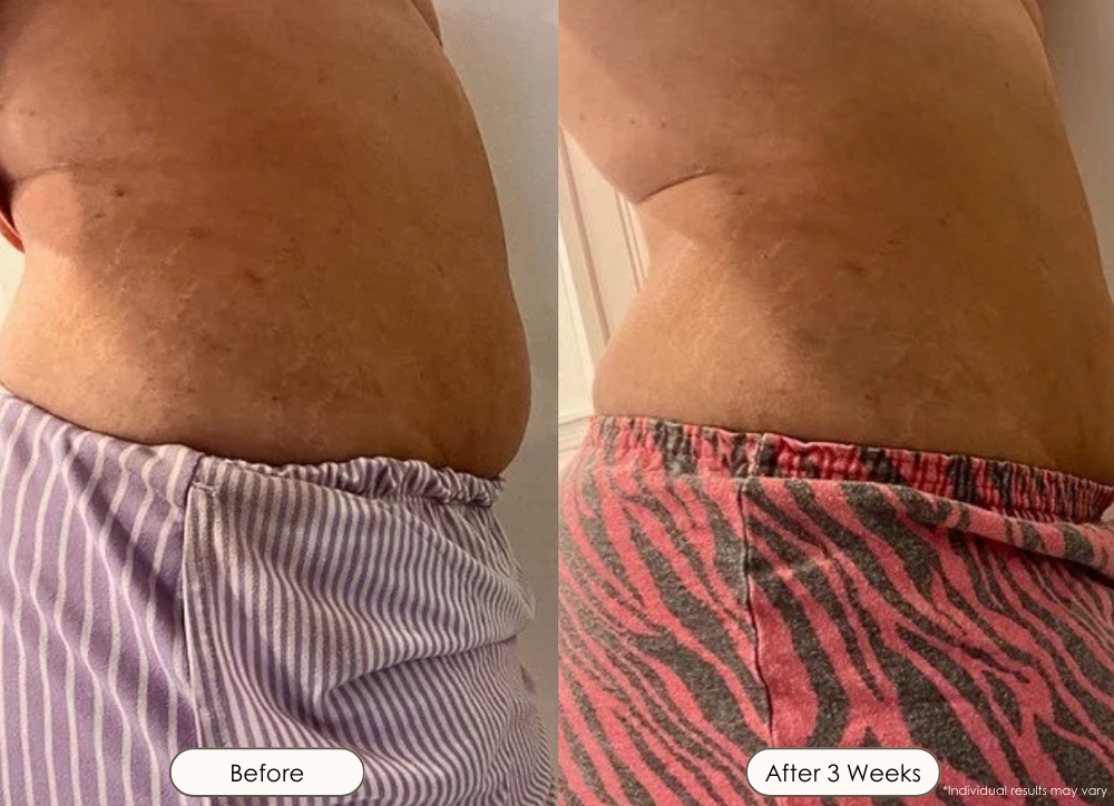 Sera vacuum body contour device before and after where there is a noticeable fat reduction in the abdomen area after 3 weeks